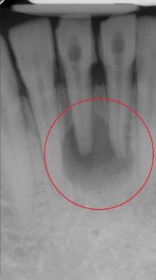 endodoncja Mikołów